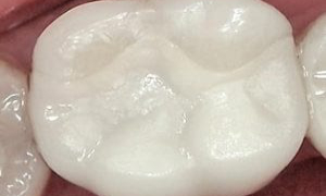 medium_After-CEREC-Crowns_2018119141026_857-300x300