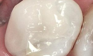 medium_After-CEREC-Crowns_201812413532_668-300x300