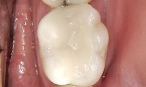 medium_After-CEREC-Onlay