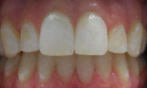 medium_After-Garcia-Invisalign