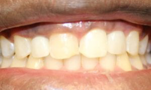 medium_After-Implant-Procedure-300x300