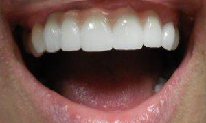 medium_After-Implants