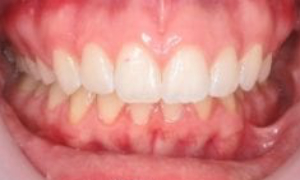 medium_After-Invisalign-300x300