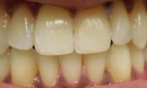 medium_After-Invisalign_201812414051_580-300x300