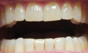 medium_After-SW-Invisalign