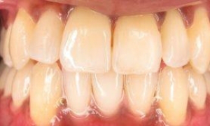 medium_After-Singh-Invisalign