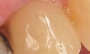 medium_After-Tooth-in-a-Day-Treatment-300x266