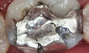 medium_Before-CEREC-Crowns_2018119141026_477-300x300