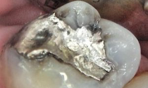 medium_Before-CEREC-Crowns_201812413532_497-300x300