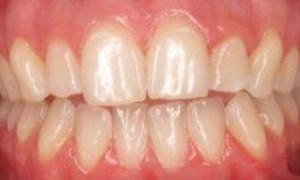 medium_Before-Garcia-Invisalign