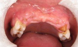 medium_Before-Implants-1