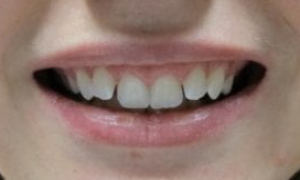 medium_Before-Invisalign-300x300