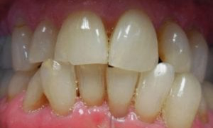 medium_Before-Invisalign-Veneers-300x300