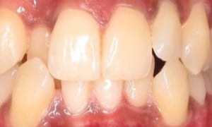medium_Before-Invisalign_201812414051_397-300x300