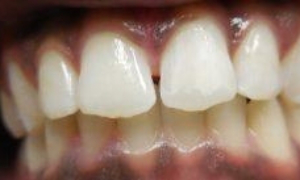 medium_Before-RW-Invisalign