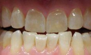 medium_Before-SW-Invisalign