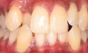 medium_Before-Singh-Invisalign