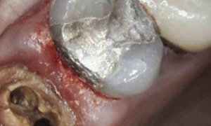 medium_Before-Tooth-in-a-Day-Treatment-300x300