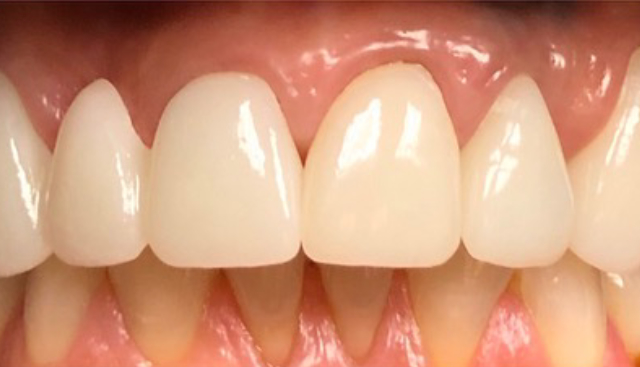 single-visit-crowns-6-units-after