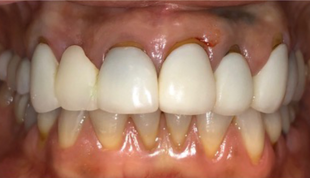 single-visit-crowns-6-units-before