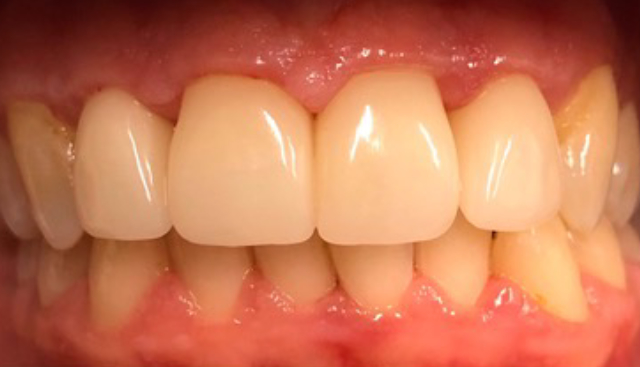 single-visit-crowns-cerec-4-crowns-after