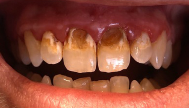 single-visit-crowns-cerec-4-crowns-before